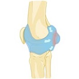 Bakers Cyst Causes